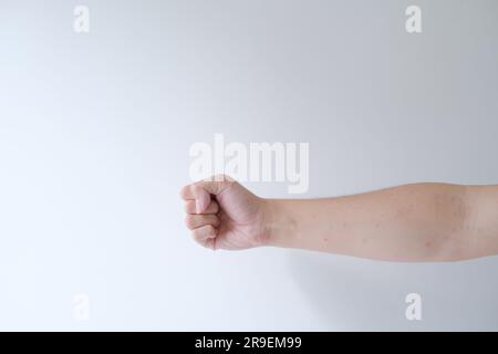 Die Hand eines Mannes mit vielen roten Flecken. Isolierter weißer Hintergrund. Stockfoto