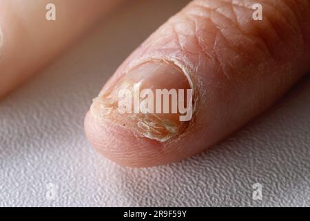 Pilzinfektion. Nagelpilz Candida am Fingernagel Stockfoto