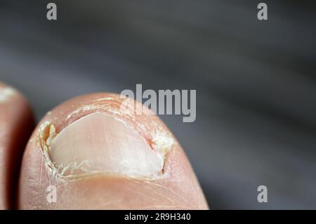 Eingewachsener Zehennagel des großen Zehens des Fußes ist eine häufige Erkrankung, bei der die Ecke oder Seite eines Zehennagels in das weiche Fleisch wächst und Schmerzen verursacht, in Stockfoto