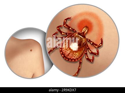 Lone Star Tick auf der Haut als Krankheit und infektiöse Zecken verbreiten Infektion als Gesundheitsgefährdung mit einem Biss eines Parasiten verursacht Infektionen Stockfoto