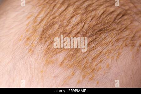 Der Entstehungsvorgang der seborrhoischen Dermatitis bei einem Säugling am Kopf. Schuppige Krusten. Stockfoto