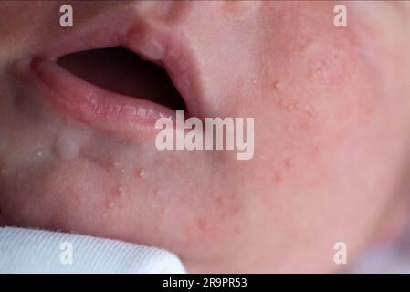 Pickel im Gesicht eines Neugeborenen. Babys Anpassung an die Umwelt. Stockfoto