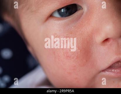 Allergische Pickel bei einem Neugeborenen im Gesicht. Pathogenese, Akne des Neugeborenen, Nahaufnahme Stockfoto