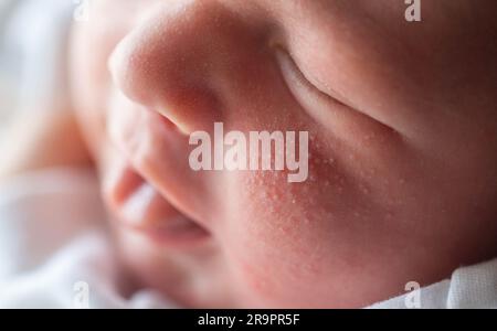 Pickel im Gesicht eines Neugeborenen. Babys Anpassung an die Umwelt. Stockfoto