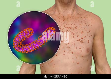 Hautausschlag bei Marburger hämorrhagischem Fieber, Illustration Stockfoto