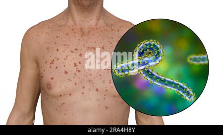 Hautausschlag bei Marburger hämorrhagischem Fieber, Illustration Stockfoto