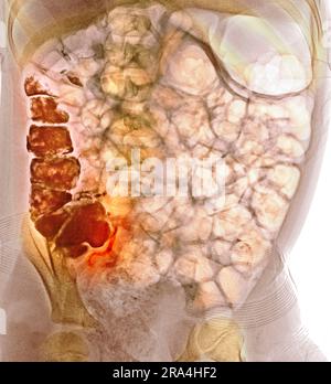 Die normale Appendikographie Stockfoto