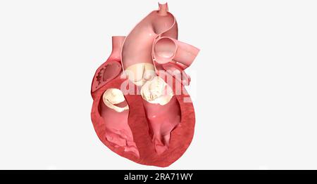 Die Kardiomyopathie ist eine Erkrankung des Herzmuskels, die das Herz