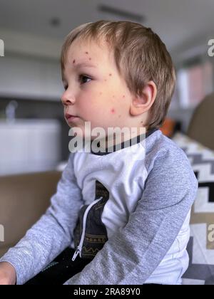 Windpocken-Blasenausschlag im kindlichen Gesicht. Krankes Kind mit Windpocken. Stockfoto