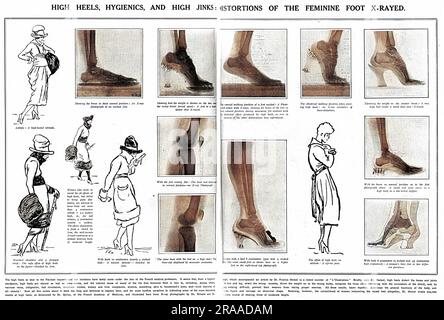 Eine Doppelseite aus dem Sketch berichtet über die unnatürlichen Belastungen, die auf die Füße durch das Tragen von hohen Absätzen, die von der französischen Ärzteschaft verboten, schlecht für die Füße und ermutigende schlechte Haltung. Frauen, die sich gegen flache Füße aussprachen, wurde empfohlen, Absätze von nicht mehr als vier Zentimetern zu tragen. Die Skizzen unter den Röntgenaufnahmen stammen von dem berühmten französischen Karikaturisten Sem. Datum: 1918 Stockfoto