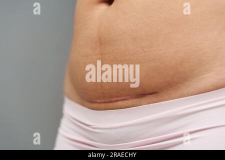 Nahaufnahme des Bauch einer Frau mit einer Kaiserschnitt-Narbe Stockfoto