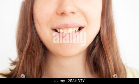 Die Person lächelt, zeigt gelbe Zahnplaque schiefe Zähne, Okklusion. Die Frau zeigt Zahnfleisch Stockfoto