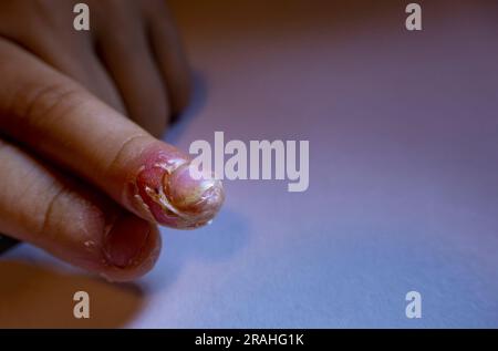 Finger geschwollen mit Entzündung durch Nagelriss-Infektion Stockfoto