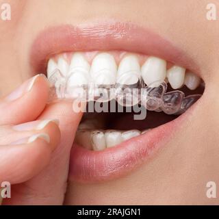 Junge Frau, die ein Whitening-Tablett mit Gel hält. Zahnaufhellung zu Hause Stockfoto