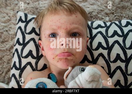 Natürliche Impfung. Ansteckende Krankheit. Krankes Kind mit Windpocken. Varicella-Virus oder Windpockenblasenausschlag auf Körper und Gesicht des Kindes. Hochwertige Fotos Stockfoto