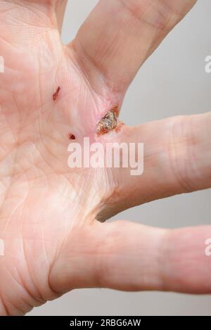 Der durch Hundebisse in der Hand verletzte Mensch. Die tiefe Wunde, die die Reißzähne zwischen den Fingern hinterlassen, ist offensichtlich Stockfoto