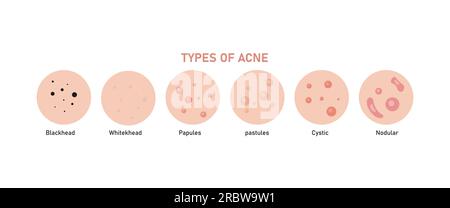 Arten von Akne, Pickel Blackheads, Whitehead, Papeln, zystisch und nodulär. Stock Vektor