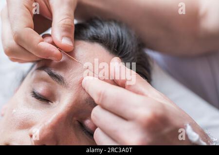 Junge Weiße mit Akupunktur-Sitzungen im Gesicht als Schönheitsbehandlung gegen das Altern. Konzept von kontrolliertem Altern, Schönheit und Körperpflege. Stockfoto