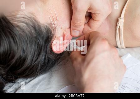 Junge Weiße mit Akupunktur-Sitzungen im Gesicht als Schönheitsbehandlung gegen das Altern. Konzept von kontrolliertem Altern, Schönheit und Körperpflege. Stockfoto