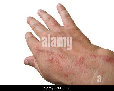 Chemische Verbrennung der Haut durch gefährliche Pflanzen. Die Hand des Menschen litt an Hogweed-Verbrennungen, bekannt als Kuhparsnips oder Riesenpfefferkraut - Palmenblick Stockfoto