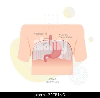 Normaler Ösophagus - großer Muskel zwischen Abdomen und Zwerchfell - Abbildung als EPS 10-Datei Stock Vektor