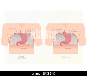 Hiatushernie - Hiatusöffnung im Zwerchfell - Bestandsdarstellung als EPS 10-Datei Stock Vektor