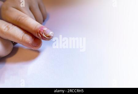 Finger geschwollen mit Entzündung durch Nagelriss-Infektion Stockfoto