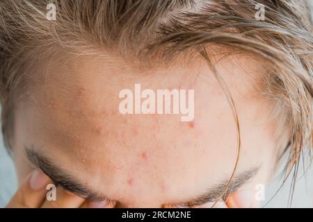 Akne auf der Stirn eines Teenagers. Das Kind ist wegen Hautproblemen verärgert Stockfoto