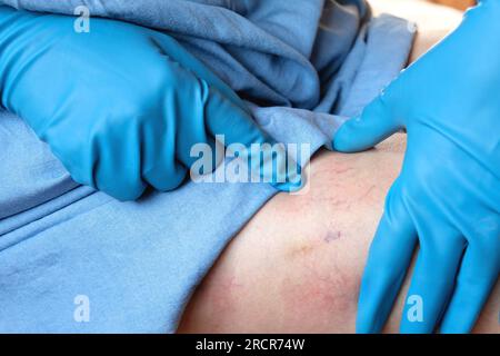 Ein Phlebologe untersucht einen Patienten mit Krampfadern am Bein. Beinschmerzen. Phlebologie. Venöse Pathologien der unteren Extremitäten. Menschliches Gefäß, arter Stockfoto