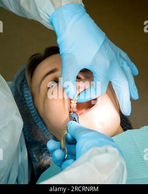 Zahnchirurg entfernt Weisheitszahn, die maxilläre dritmolare Patientin. Echte Prozedur. Nahaufnahme Stockfoto