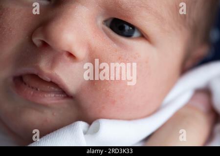 Allergische Pickel bei einem Neugeborenen im Gesicht. Pathogenese, Akne des Neugeborenen, Nahaufnahme Stockfoto