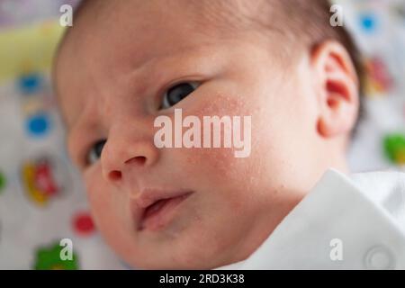 Pickel im Gesicht eines Neugeborenen. Babys Anpassung an die Umwelt. Stockfoto