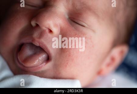 Pickel im Gesicht eines Neugeborenen. Babys Anpassung an die Umwelt. Stockfoto