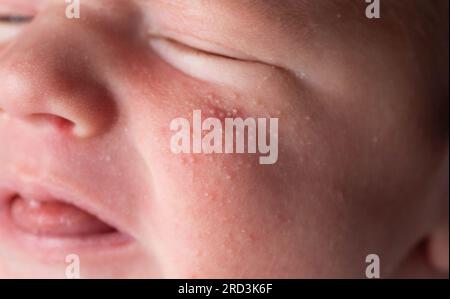 Allergische Pickel bei einem Neugeborenen im Gesicht. Pathogenese, Akne des Neugeborenen, Nahaufnahme Stockfoto