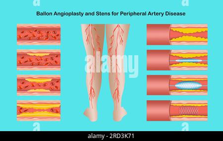 Abbildung: Angioplastie bei peripherer arterieller Verschlusskrankheit. Begriff der trockenen Haut, alter Senioren, Krampfadern und TVT. Stockfoto