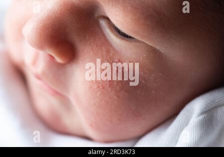 Allergische Pickel bei einem Neugeborenen im Gesicht. Pathogenese, Akne des Neugeborenen, Nahaufnahme Stockfoto