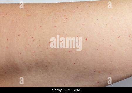Viele kleine Hämangiome und ein paar Altersflecken auf der Oberarmhaut einer 55 Jahre alten Kaukasierin. Abnorme Anzahl von Flecken und Alter des Patienten. Stockfoto