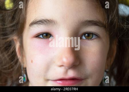 Ein rotes geschwollenes Augenlid auf einem Kindergesicht in Nahaufnahme ist eine Allergie gegen einen Insektenbiss. Allergische Reaktion auf blutsaugende Insekten Stockfoto