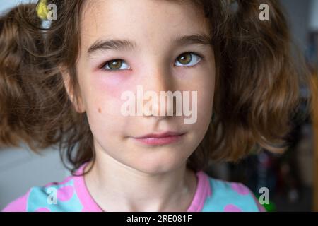 Ein rotes geschwollenes Augenlid auf einem Kindergesicht in Nahaufnahme ist eine Allergie gegen einen Insektenbiss. Allergische Reaktion auf blutsaugende Insekten Stockfoto