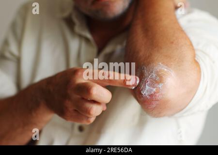 Auftragen eines Creme-Weichmachers auf trockene schuppige Haut wie bei der Behandlung von Psoriasis, Ekzemen und anderen trockenen Hauterkrankungen Stockfoto