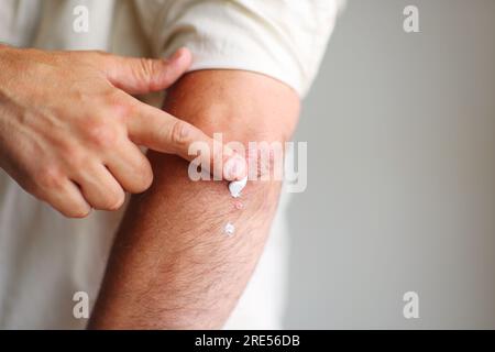 Auftragen eines Creme-Weichmachers auf trockene schuppige Haut wie bei der Behandlung von Psoriasis, Ekzemen und anderen trockenen Hauterkrankungen Stockfoto