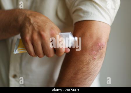 Psoriasis. Autoimmune genetische Erkrankung. Ein Mann mit Wunden Händen, trockener schuppiger Haut am Arm mit Psoriasis vulgaris, Ekzem. Stockfoto