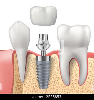 Zähne und Zahnimplantate realistische Vektorgestaltung der Zahnheilkunde. 3D Zahn, Zahnkrone, Kieferknochen und gesunde Wurzeln, Implantatschraube und Pfeiler, Gesundheitswesen, Zahnarzt und Kieferorthopädie Behandlung Stock Vektor