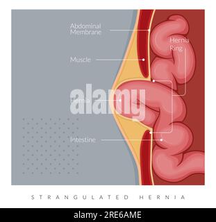 Strangulierter Hernie - Abschnitt des Dünndarms - Stockillustration als EPS 10 Datei Stock Vektor