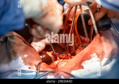 Nahaufnahme der Hände von Chirurgen, die eine komplexe Operation in der offenen Brusthöhle des Patienten durchführen. Einsatz chirurgischer Instrumente und c Stockfoto