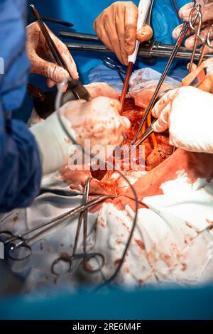 Nahaufnahme der Hände von Chirurgen, die eine komplexe Operation in der offenen Brusthöhle des Patienten durchführen. Einsatz chirurgischer Instrumente und c Stockfoto