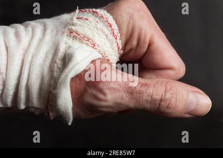 Nahaufnahme einer bandagierten Hand mit Resten einer Verbrennung zweiten Grades auf dem Daumenschenkel und die Folgen einer Brandverletzung auf einem schwarzen Ba Stockfoto