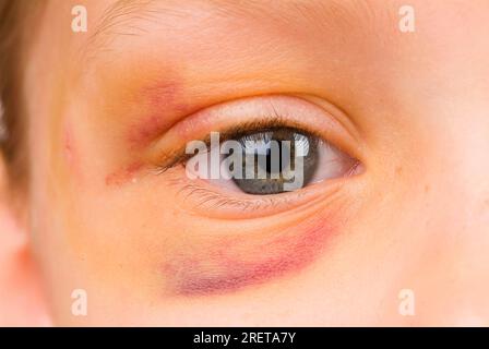 Mädchen mit Verletzung, blauem Auge, Hämatom, Bluterguss, Kindesmisshandlung Stockfoto