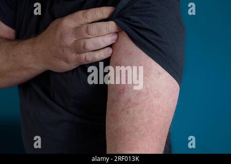 Am Unterarm erscheint ein roter Ausschlag. Erysipel an Arm und oberer Handfläche Stockfoto