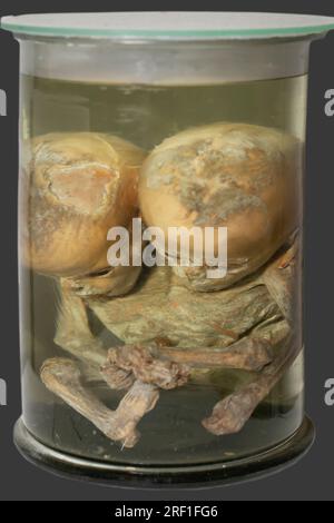 1. April 2023 - Gomel: Vollständig plastinierte siamesische Zwillinge auf einer anatomischen Ausstellung mit plastinierten Leichen. Einbalsamierte siamesische Zwillinge. Stockfoto